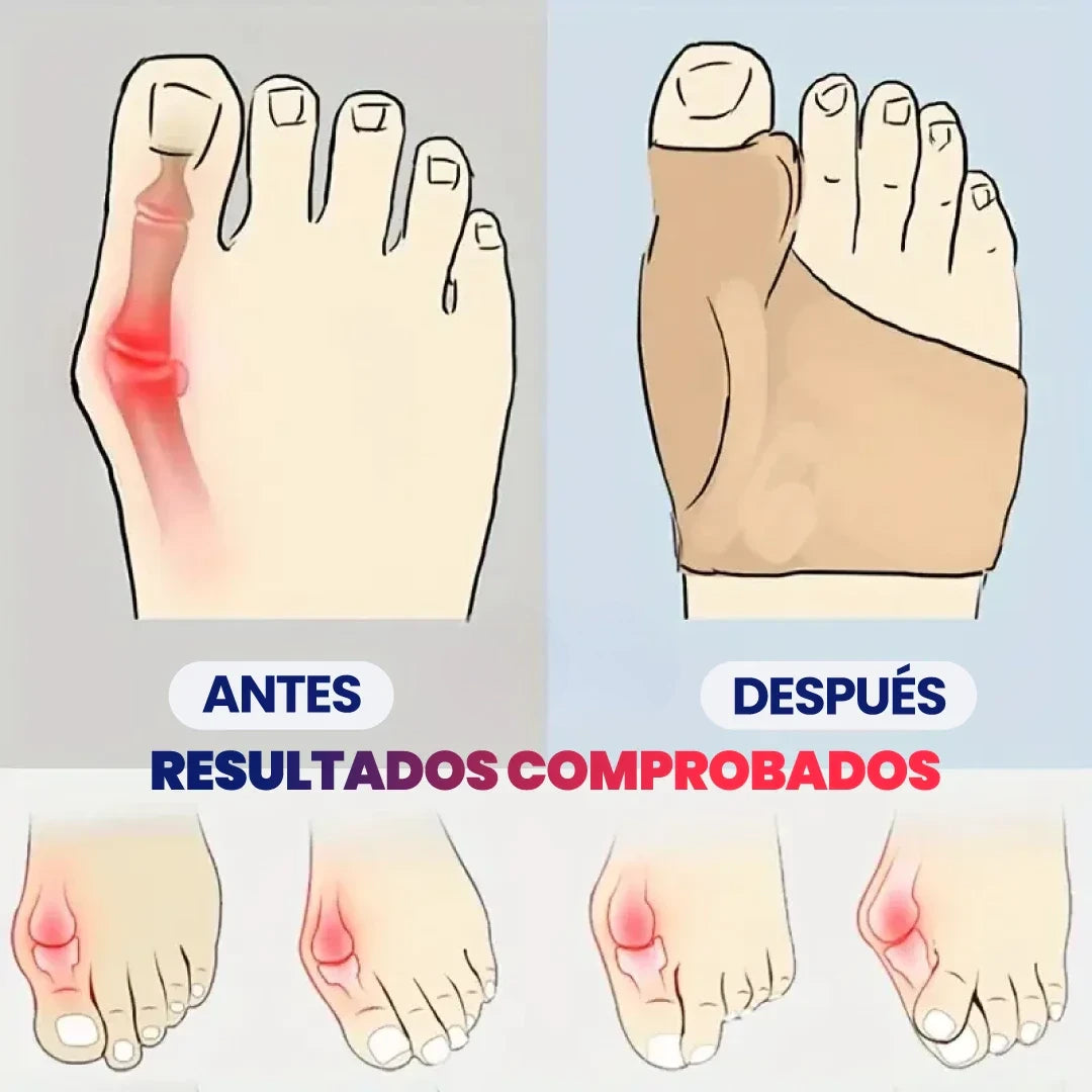 Corrector de Juanetes con almohadilla de gel  (1 par)